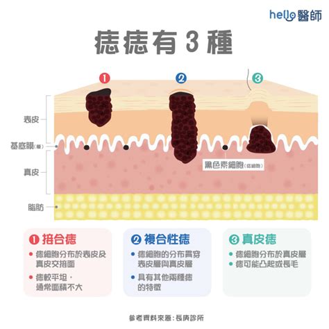 手臂長痣|痣變大、痣多或長毛會變皮膚癌？認識痣的形成與原因